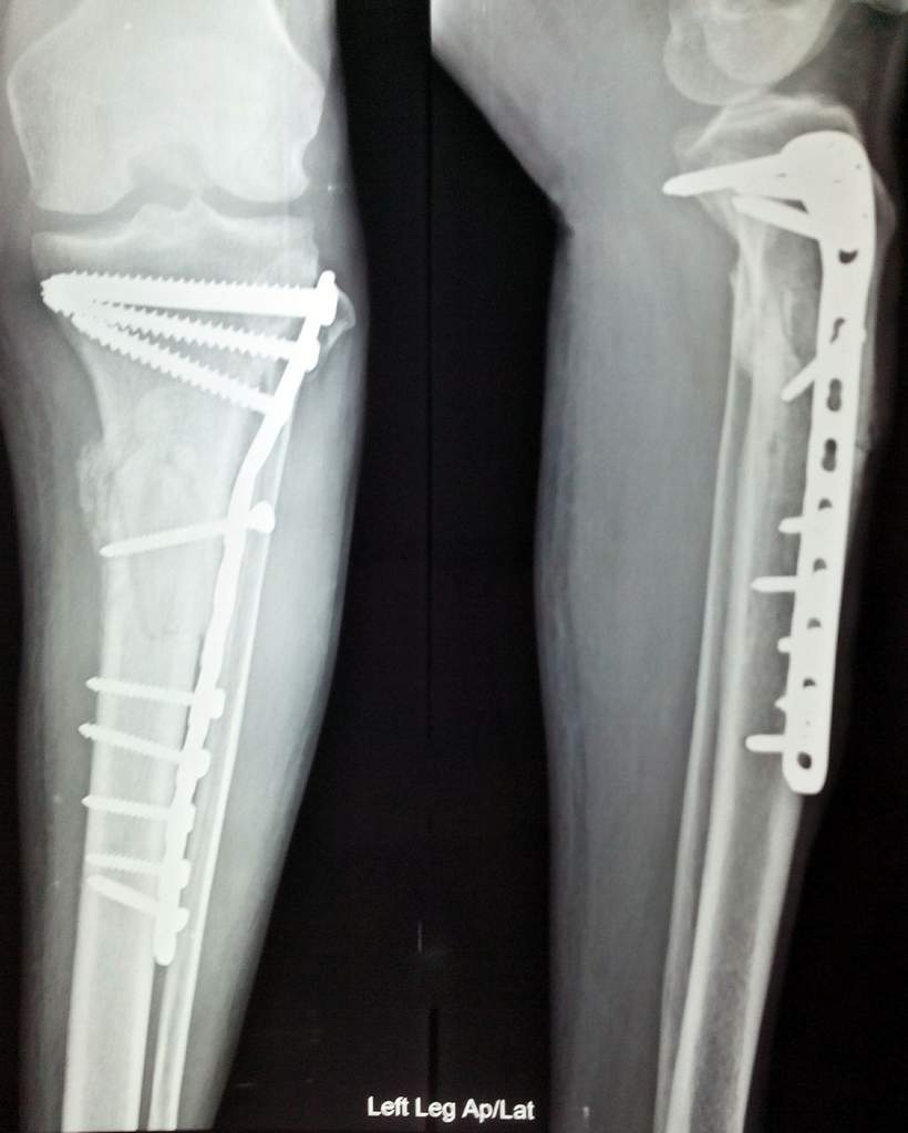 Lower Leg (Tibia & Fibula) Fracture Claims Florida