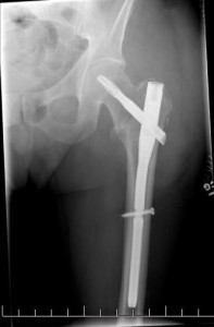 Broken Hip Settlements (Car and Motorcycle Accidents, Falls and More)