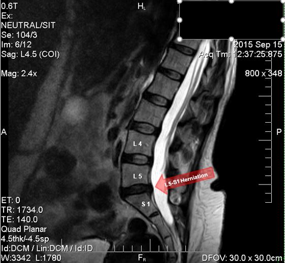 L5-S1 herniation