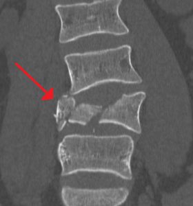 Burst Fracture Settlements (Car Accidents, Falls and More)