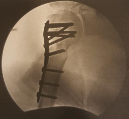 X-ray of hardware inside upper arm bone (humerus)