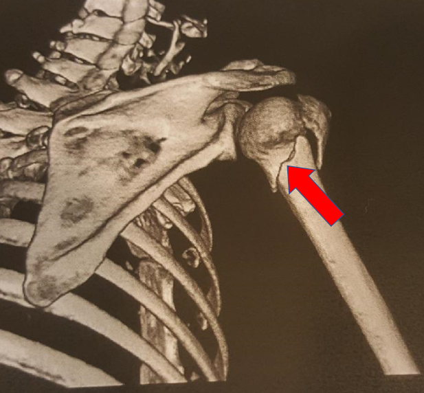 MRI image showing proximal humerus fracture (upper arm bone)