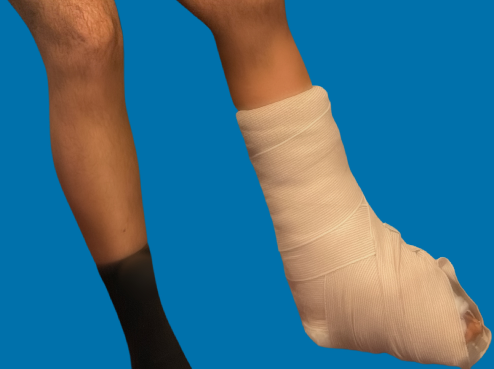 Broken Ankle Settlements (Car Accident Claims, Falls and More)